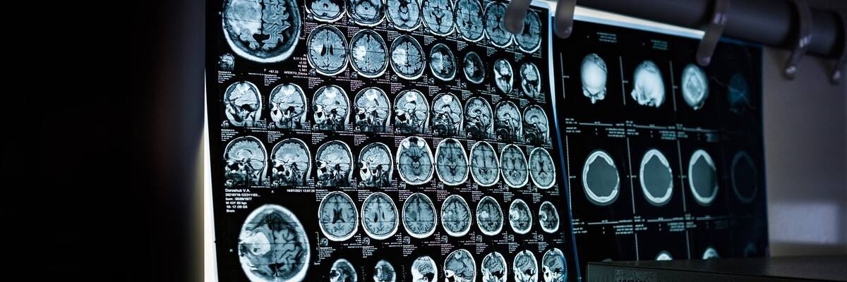 Choroba Parkinsona może mieć te nieoczywiste objawy. Jeśli je zauważysz, idź do lekarza
